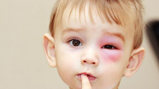 Jenis Alergi yang Biasa Menyerang Anak-Anak