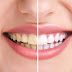 Tẩy trắng răng có lợi ích gì?