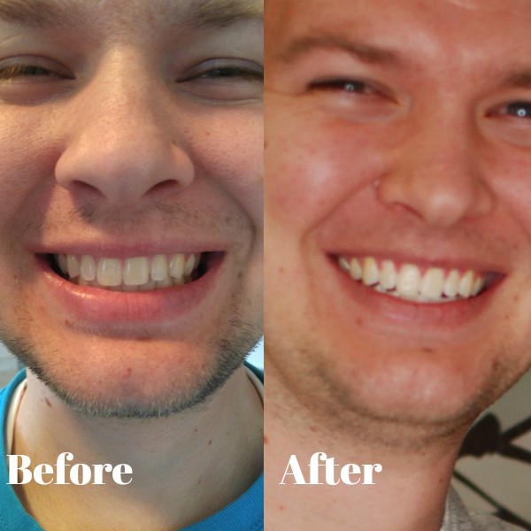 Does Laser Teeth Whitening Really Work?