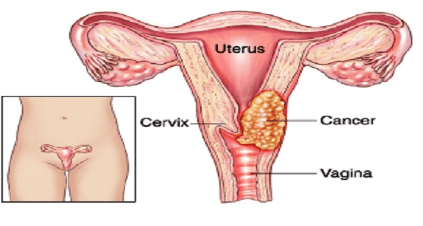 cervical-cancer-signs-and-symptoms