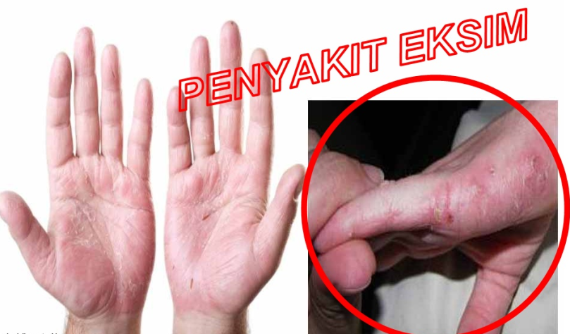 obat eksim kaki