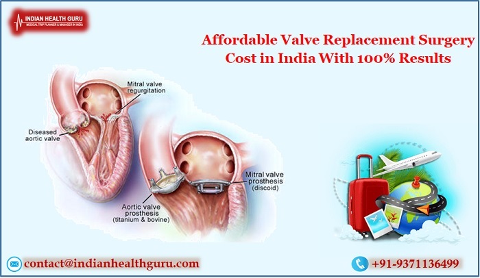 Affordable Valve Replacement Surgery Cost in India