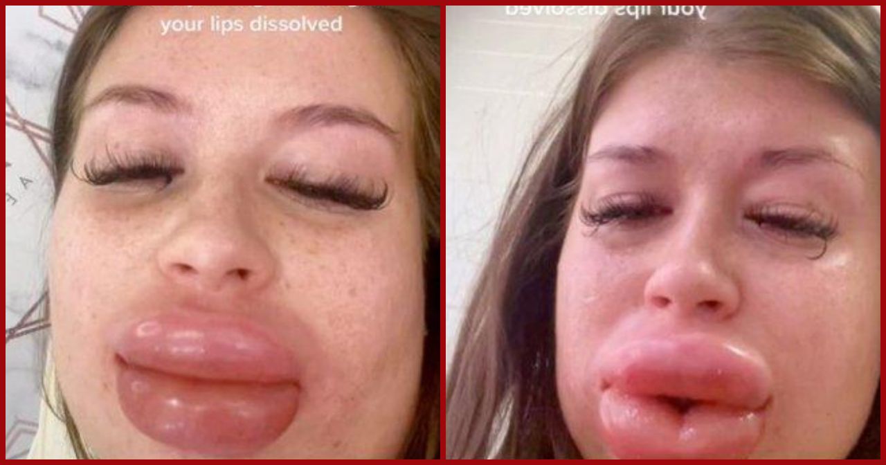 RINTIHAN Karli Gardner Tahan Perih Bibirnya Mau 'Meledak' Akibat Gagal Operasi Filler Bibir