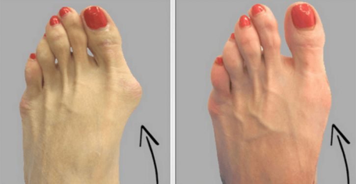 An Old Natural Remedy To Say Goodbye To Your Hallux Valgus