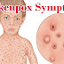 Chickenpox