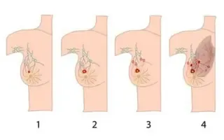 كيفية تحديد مراحل سرطان الثدي؟