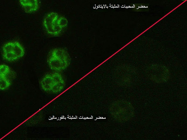 أنماط الفلورة لأضداد سيتوبلاسما الكريات البيضاء ANCA الغير نظامية 