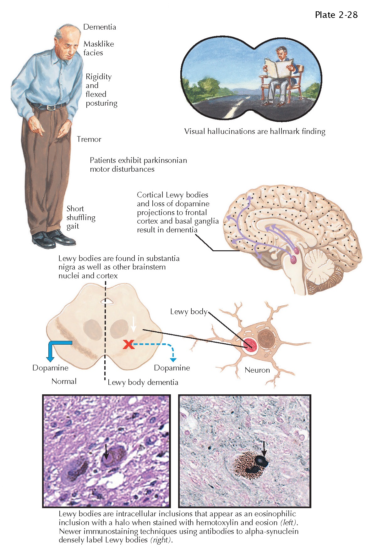 DEMENTIA WITH LEWY BODIES