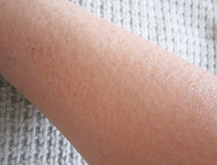 my dry arm, bitsandtreats my dry arm, bitsandtreats