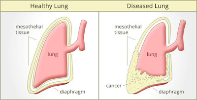 mesothelioma survival rates