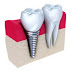 Nên biết ưu điểm của trụ răng implant Osstem