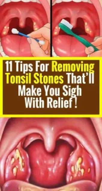 Tips On Removing Tonsil Stones With Relief !