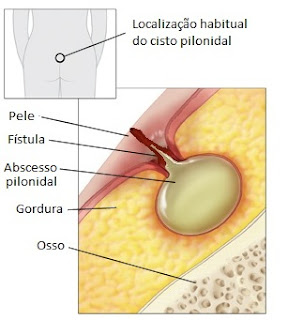 Abscesso pilonidal