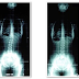 Tratamento Escoliose – Reeducação Postural Global