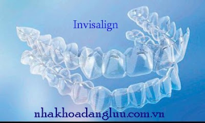 Niềng răng invisalign tại việt nam như thế nào ?