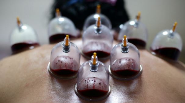 Hijama Benefits for Heart Disease