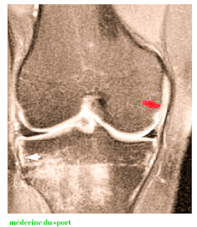 IMAGERIE DU GENOU APPLIQUÉE A LA PATHOLOGIE SPORTIVE