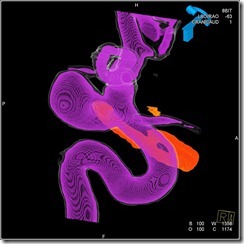 12 YRS POST CLIPPING RECURRENCE two color5_2