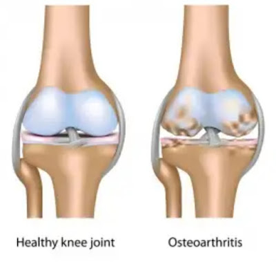 cidera olahraga Osteoarthritis