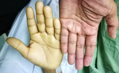 Anaemia root cause of various diseases in J&amp;K, more awareness needed, say doctors