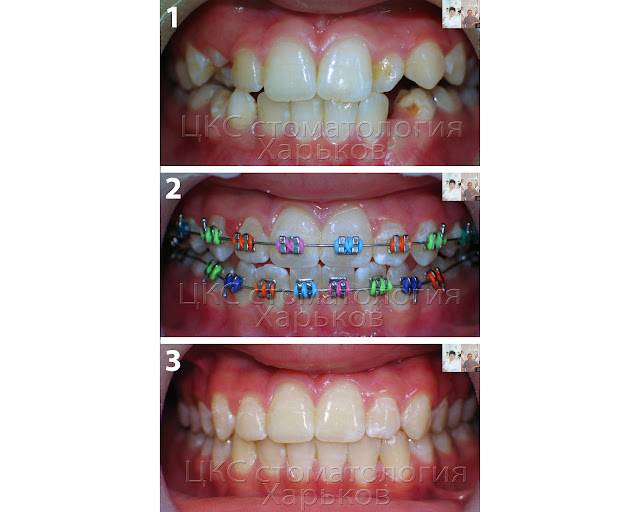 Прикус до и после проведения раннего ортодонтического лечения