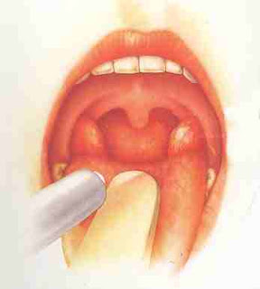 tonsil