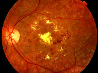 retinopatía diabética