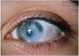 Cara mengobati glaukoma secara alami