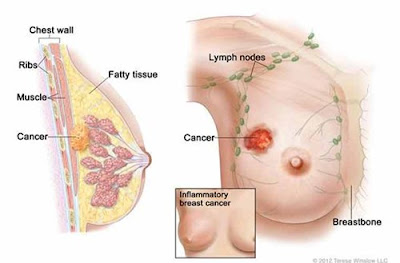Chữa ung thư vú bằng nấm lim xanh