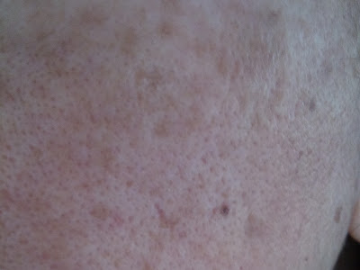 Old age spots on skin 109431-Black spots on skin old age