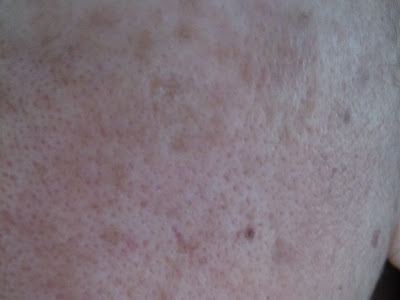 Old age spots on skin 109431-Black spots on skin old age
