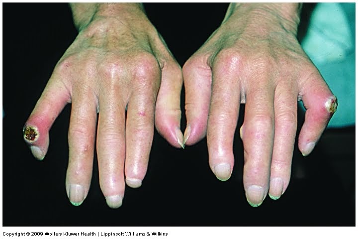 Can Massage Therapy Help With Scleroderma?