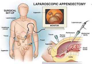 Laparaskopi-appendiktomi