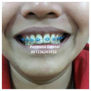 gambar foto behel bracket kawat gigi sebelum dan sesudah perawatan untuk memperbaiki merapikan gigi gingsul gigi miring renggang tonggos berantakan keluar masuk jarang diastema maju mundur tidak rapi tidak beraturan bali denpasar banyuwangi jember tidak rata kocar kacir