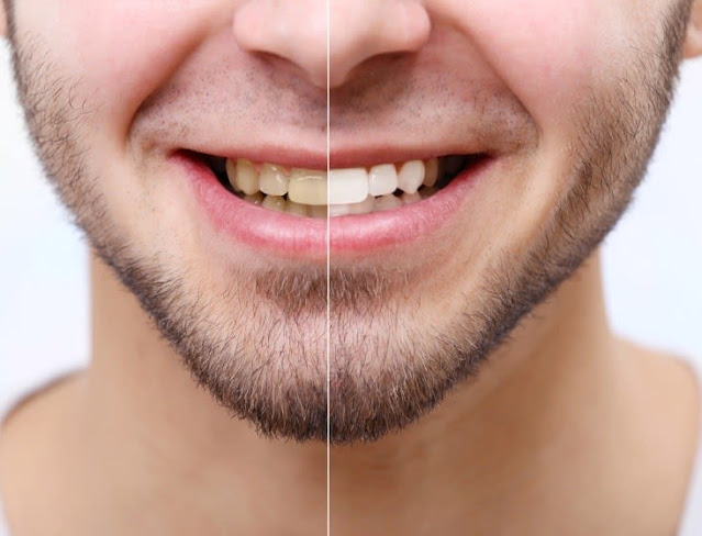 وصفات طبيعية للعناية بصحة الأسنان وتبييضها