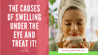 The causes of swelling under the eye and treat it!