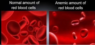 Gejala yang ditimbulkan akibat kadar hemoglobin rendah