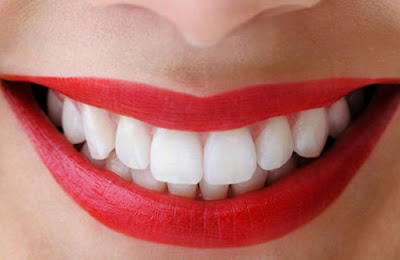  Làm cầu răng sứ có bền không?