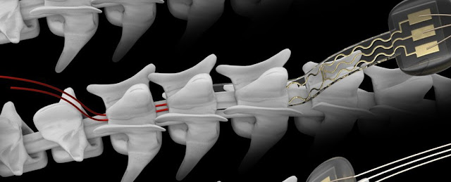 Radial Head Resection Implants