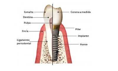 ¿Cómo es la cirugía de implantes dentales?