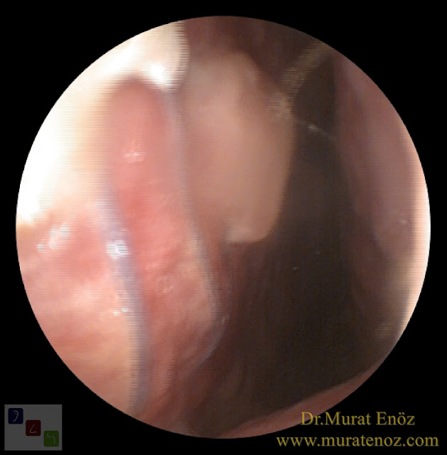 Ekstrakorporeal septum perforasyonu tamiri - Ekstrakorporeal septum perforasyonu ameliyatı - Septum perforasyonu tedavisi - Nazal septum perforasyonu operasyonu - Açık teknik ekstrakorporeal septum perforasyonu ameliyatı - Açık teknik ekstrakorporeal septum perforasyonu onarımı - Burun estetiği ile birlikte ekstrakorporeal septum perforasyonu kapatılması - Ekstrakorporeal burun septumunda delik kapatılması - Burunda delik oluşumu - Burun duvarında delik - Burun kıkırdak delinmesi tedavisi - Septum perforasyonu ameliyatı olanlar - Septum perforasyonu olanlar - Septal perforasyon tamiri - Ekstrakorporeal burun septum perforasyonu ameliyatı - Extracorporeal septum perforation closure in Istanbul - Extracorporeal septum perforation closure in Turkey - Extracorporeal closure of nasal septal perforations subcutaneous tissue - Combining rhinoplasty with extracorporeal septal perforation repair