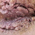 Obat Alami Kondiloma thumbnail