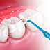  Cạo vôi răng bằng sóng siêu âm có ưu điểm gì?