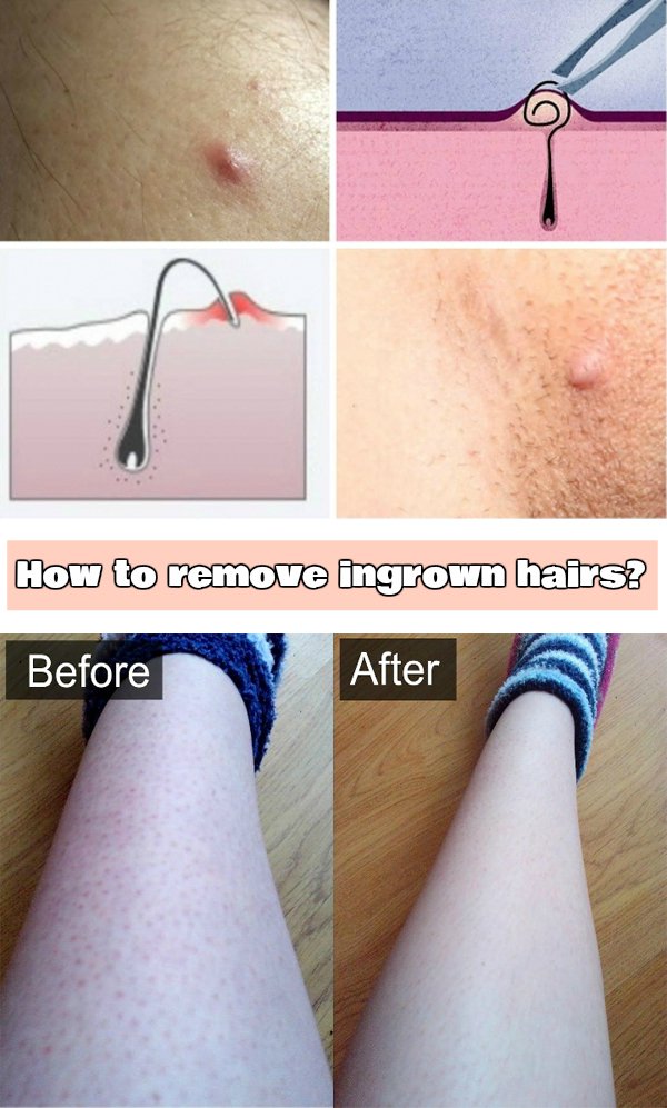 See Here: Easy Tips How to Remove Ingrown Hair Easily ...
