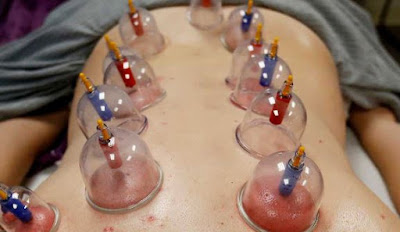 illnesses that are treated by cupping therapy