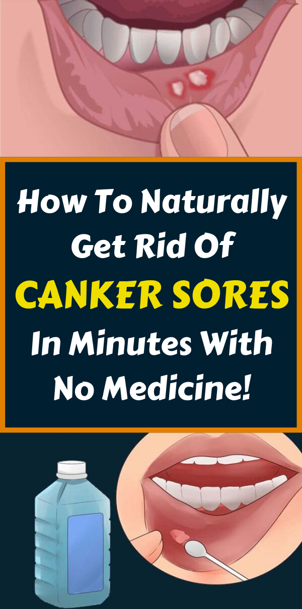How to cure canker sores and mouth sores? Remedy Day