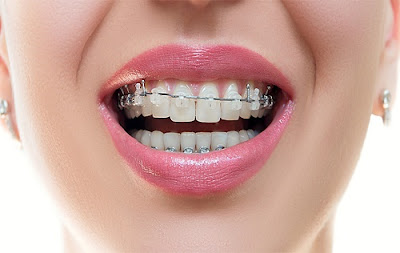 Niềng răng hô là phương pháp gì?