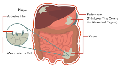 Mesothelioma Peritoneal