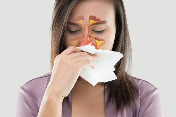 علاج التهاب الجيوب الأنفية  (Sinusitis)