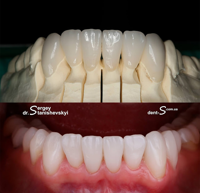 стоматолог стоматология Виниры Киев Станишевский Сергей накладки коронки керамика керамические